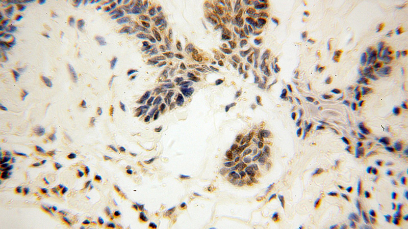 Immunohistochemical of paraffin-embedded human skin cancer using Catalog No:112141(TMPO antibody) at dilution of 1:100 (under 40x lens)
