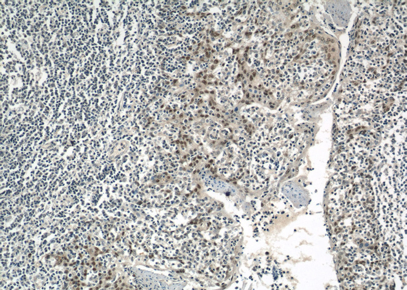 Immunohistochemical of paraffin-embedded human tonsillitis using Catalog No:113840(PITX1 antibody) at dilution of 1:50 (under 10x lens)