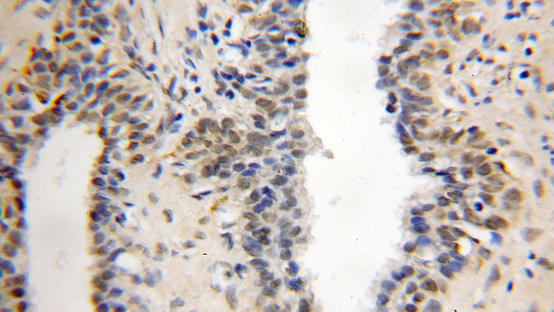 Immunohistochemical of paraffin-embedded human prostate cancer using Catalog No:116891(YPEL5 antibody) at dilution of 1:25 (under 10x lens)