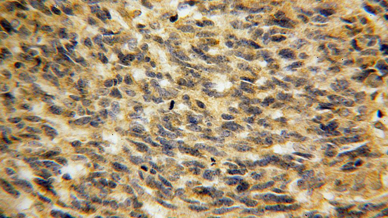 Immunohistochemical of paraffin-embedded human gliomas using Catalog No:115398(SMOX antibody) at dilution of 1:100 (under 40x lens)