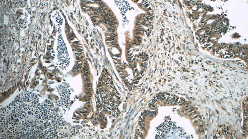 Immunohistochemistry of paraffin-embedded human pancreas cancer tissue slide using Catalog No:107583(AMY2A Antibody) at dilution of 1:50(under 10x lens)