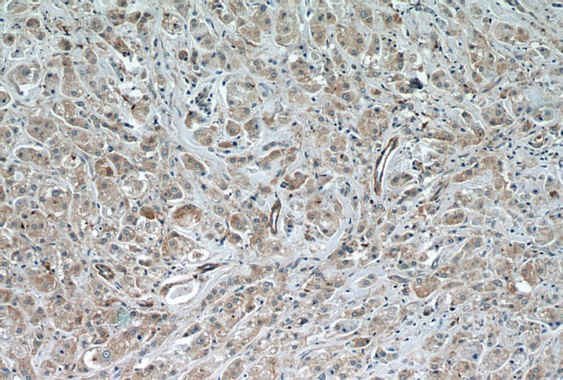 Immunohistochemistry of paraffin-embedded human breast cancer slide using Catalog No:108994(CCDC99 Antibody) at dilution of 1:50 (under 10x lens)