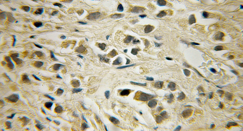 Immunohistochemical of paraffin-embedded human prostate cancer using Catalog No:115281(SHPK antibody) at dilution of 1:50 (under 10x lens)