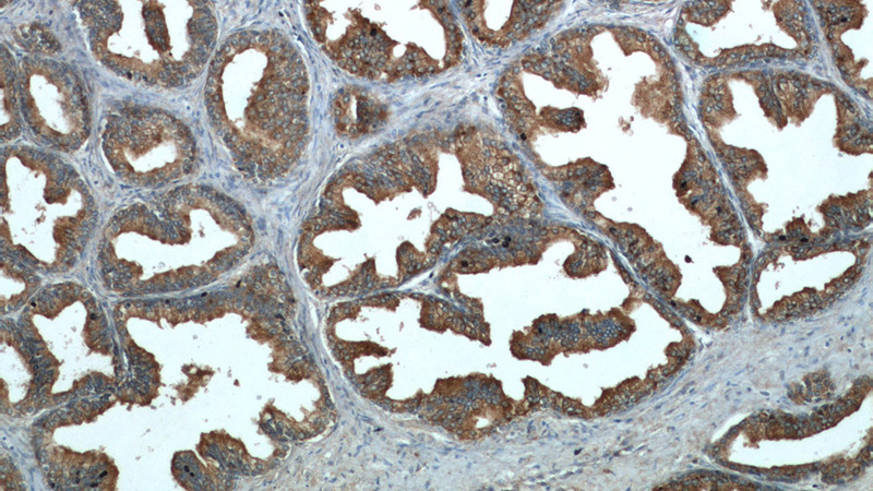 Immunohistochemical of paraffin-embedded human prostate hyperplasia using Catalog No:113323(ODC1 antibody) at dilution of 1:50 (under 10x lens)