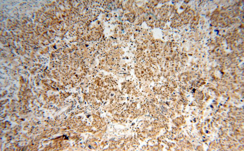 Immunohistochemical of paraffin-embedded human ovary tumor using Catalog No:115610(SSRP1 antibody) at dilution of 1:100 (under 10x lens)