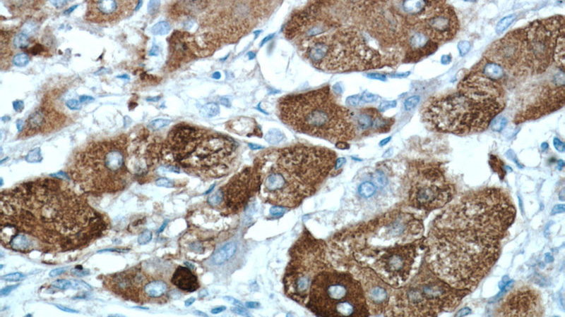 Immunohistochemical of paraffin-embedded human hepatocirrhosis using Catalog No:110232(ELOVL6 antibody) at dilution of 1:100 (under 40x lens)