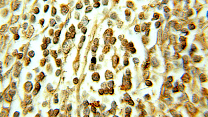 Immunohistochemical of paraffin-embedded human lymphoma using Catalog No:109928(DHX16 antibody) at dilution of 1:10 (under 10x lens)