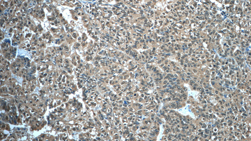 Immunohistochemistry of paraffin-embedded human breast cancer tissue slide using Catalog No:110422(EYA3 Antibody) at dilution of 1:50 (under 10x lens)