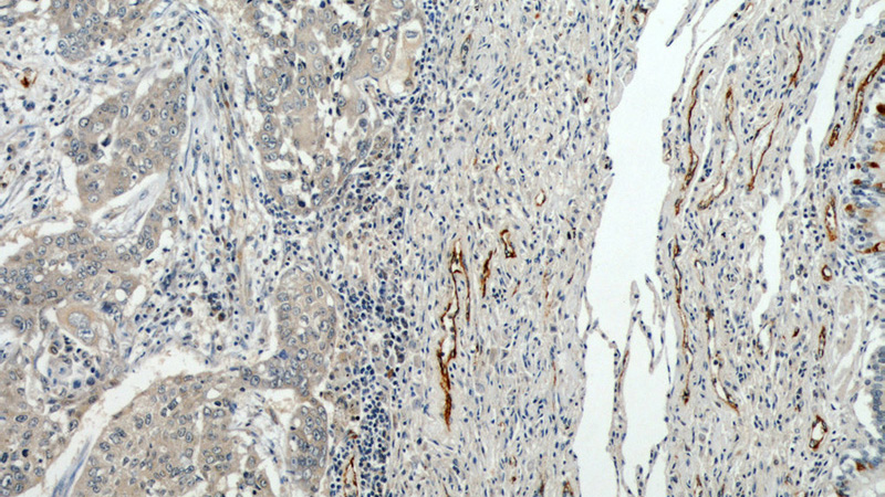 Immunohistochemical of paraffin-embedded human lung cancer using Catalog No:114298(SELP antibody) at dilution of 1:50 (under 10x lens)