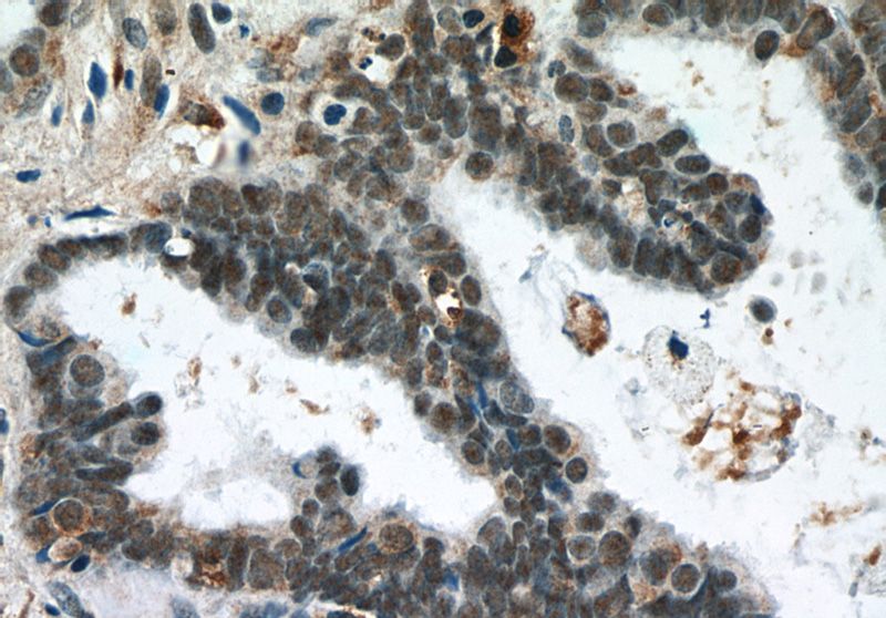 Immunohistochemistry of paraffin-embedded human ovary tumor tissue slide using Catalog No:116053(THRAP3 Antibody) at dilution of 1:50