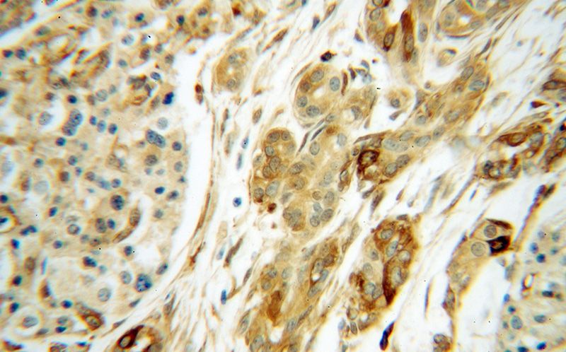 Immunohistochemical of paraffin-embedded human pancreas cancer using Catalog No:114841(RPS28 antibody) at dilution of 1:50 (under 40x lens)