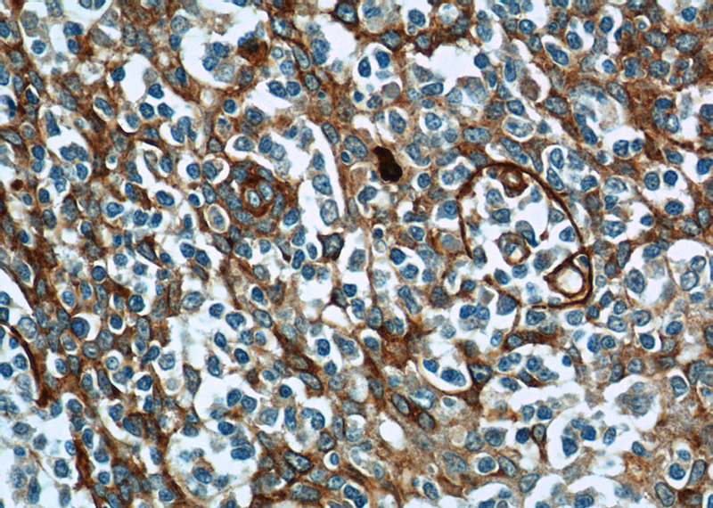 Immunohistochemistry of paraffin-embedded human tonsillitis tissue slide using Catalog No:107768(ADAM8 Antibody) at dilution of 1:50 (under 40x lens)