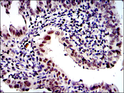 Immunohistochemical analysis of paraffin-embedded intima cancer tissues using PSMB8 mouse mAb with DAB staining.