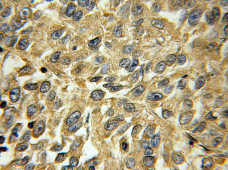 Immunohistochemical of paraffin-embedded human lung cancer using Catalog No:115338(SLC25A6 antibody) at dilution of 1:50 (under 10x lens)
