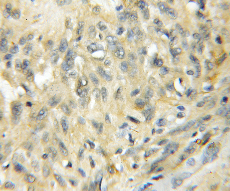 Immunohistochemical of paraffin-embedded human gliomas using Catalog No:115289(SKP1 antibody) at dilution of 1:50 (under 10x lens)