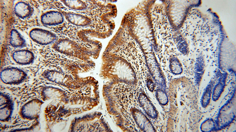 Immunohistochemical of paraffin-embedded human colon using Catalog No:117238(PTK6 antibody) at dilution of 1:100 (under 10x lens)