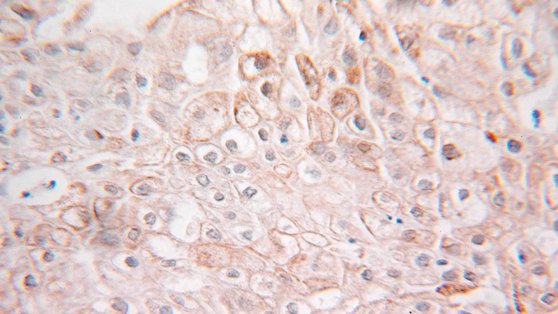 Immunohistochemical of paraffin-embedded human ovary tumor using Catalog No:116339(TRAPA, SSR1 antibody) at dilution of 1:100 (under 25x lens)