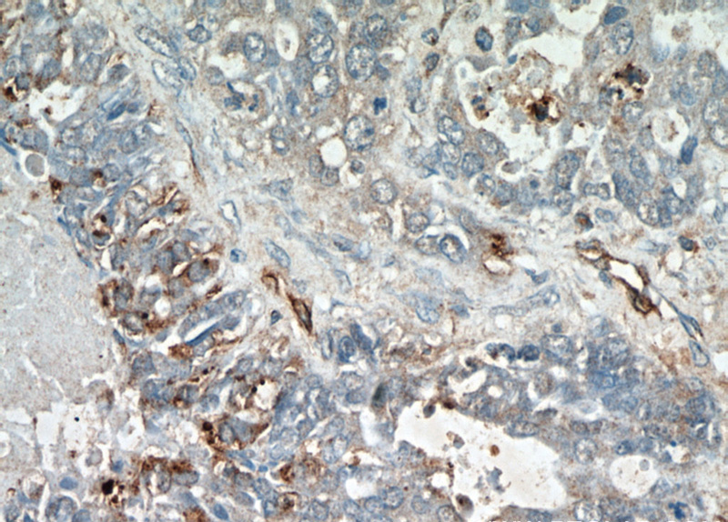 Immunohistochemical of paraffin-embedded human ovary tumor using Catalog No:112807(ABCC5 antibody) at dilution of 1:50 (under 40x lens)