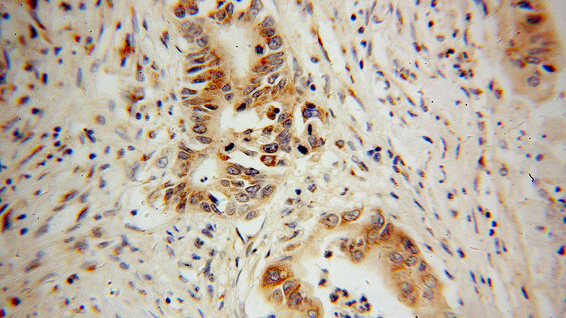 Immunohistochemical of paraffin-embedded human pancreas cancer using Catalog No:113170(NGB antibody) at dilution of 1:100 (under 40x lens)