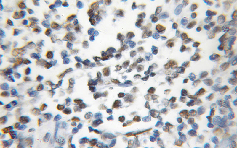Immunohistochemical of paraffin-embedded human lymphoma using Catalog No:114509(RAD1 antibody) at dilution of 1:50 (under 10x lens)