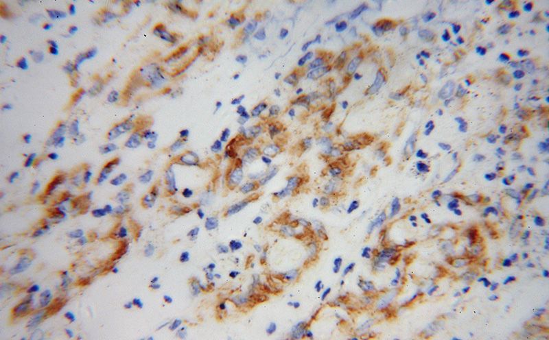 Immunohistochemical of paraffin-embedded human stomach cancer using Catalog No:115543(SPARC antibody) at dilution of 1:100 (under 40x lens)