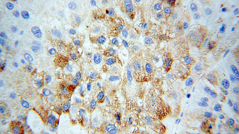 Immunohistochemical of paraffin-embedded human liver cancer using Catalog No:113747(PCOLCE antibody) at dilution of 1:100 (under 40x lens)
