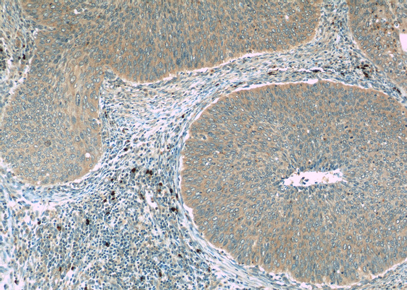 Immunohistochemistry of paraffin-embedded human cervical cancer slide using Catalog No:110577(FAM168B Antibody) at dilution of 1:50 (under 10x lens)