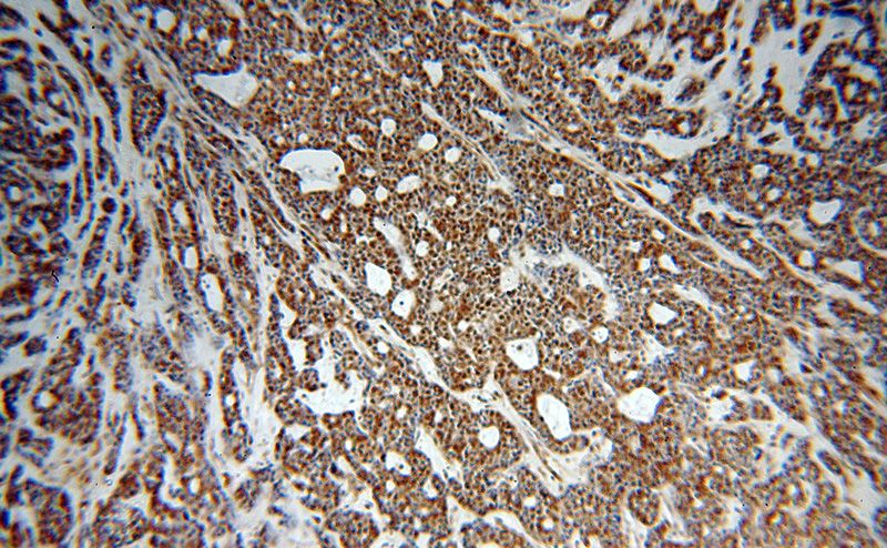 Immunohistochemical of paraffin-embedded human cervical cancer using Catalog No:113046(NCOR1 antibody) at dilution of 1:100 (under 10x lens)
