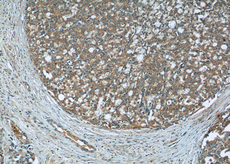 Immunohistochemistry of paraffin-embedded human prostate cancer tissue slide using Catalog No:107493(RABEP2 Antibody) at dilution of 1:50 (under 10x lens)