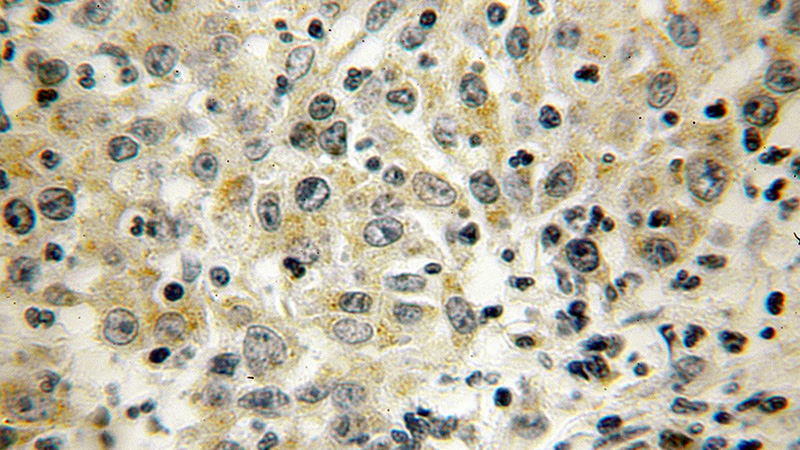 Immunohistochemical of paraffin-embedded human colon cancer using Catalog No:109707(CYP4F12 antibody) at dilution of 1:100 (under 40x lens)