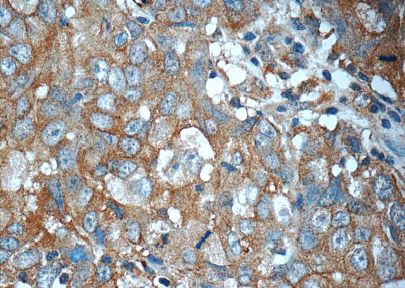 Immunohistochemistry of paraffin-embedded human breast cancer tissue slide using Catalog No:108101(ANO2 Antibody) at dilution of 1:50 (under 40x lens)