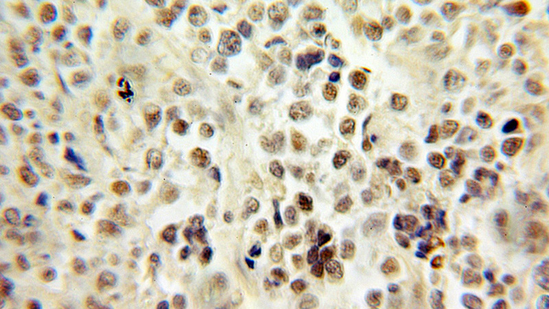 Immunohistochemical of paraffin-embedded human lymphoma using Catalog No:114029(PMS1 antibody) at dilution of 1:100 (under 10x lens)