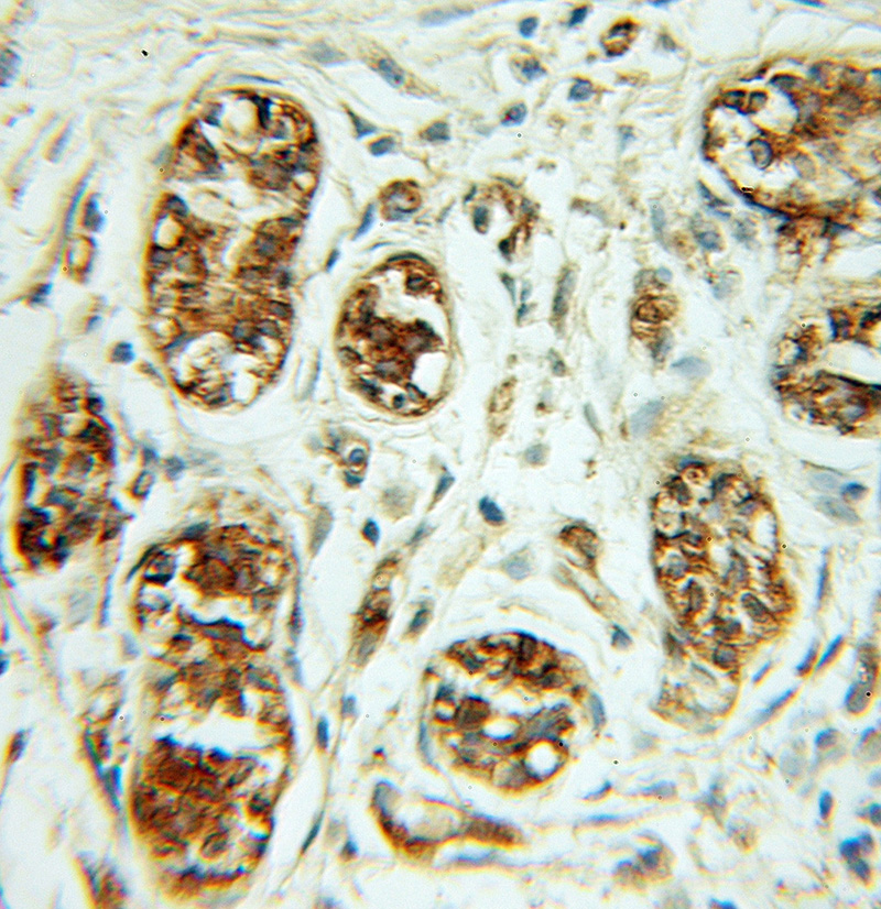Immunohistochemical of paraffin-embedded human breast cancer using Catalog No:116458(TXNRD1 antibody) at dilution of 1:100 (under 10x lens)