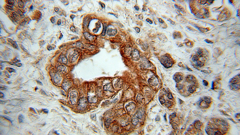 Immunohistochemical of paraffin-embedded human pancreas cancer using Catalog No:110754(FXYD2 antibody) at dilution of 1:100 (under 10x lens)
