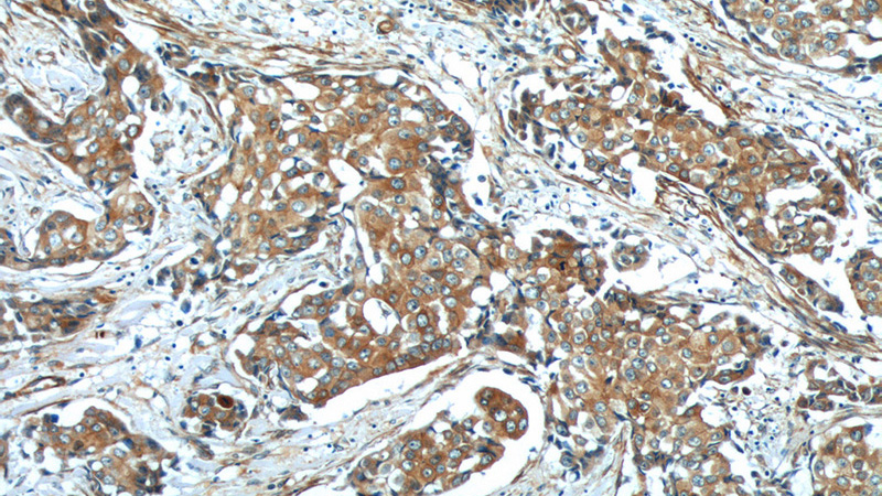 Immunohistochemistry of paraffin-embedded human breast cancer tissue slide using Catalog No:109154(CDH26 Antibody) at dilution of 1:50 (under 10x lens)