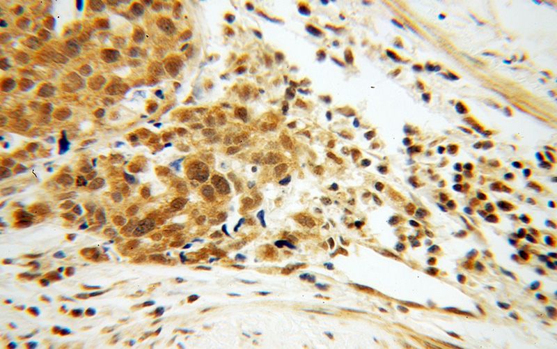 Immunohistochemical of paraffin-embedded human ovary tumor using Catalog No:110202(EIF4A2 antibody) at dilution of 1:100 (under 40x lens)