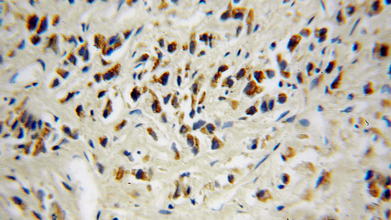 Immunohistochemical of paraffin-embedded human prostate cancer using Catalog No:110052(DOK4 antibody) at dilution of 1:50 (under 40x lens)
