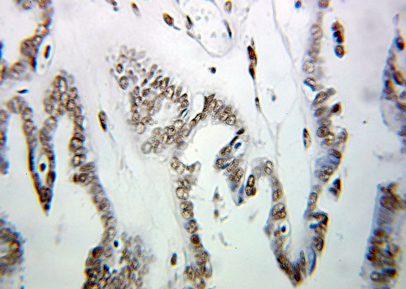 Immunohistochemical of paraffin-embedded human ovary tumor using Catalog No:111514(HNRNPUL1 antibody) at dilution of 1:100 (under 25x lens)