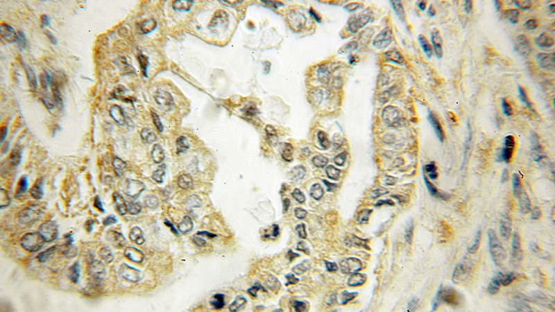 Immunohistochemical of paraffin-embedded human pancreas cancer using Catalog No:109727(CTNS antibody) at dilution of 1:100 (under 10x lens)