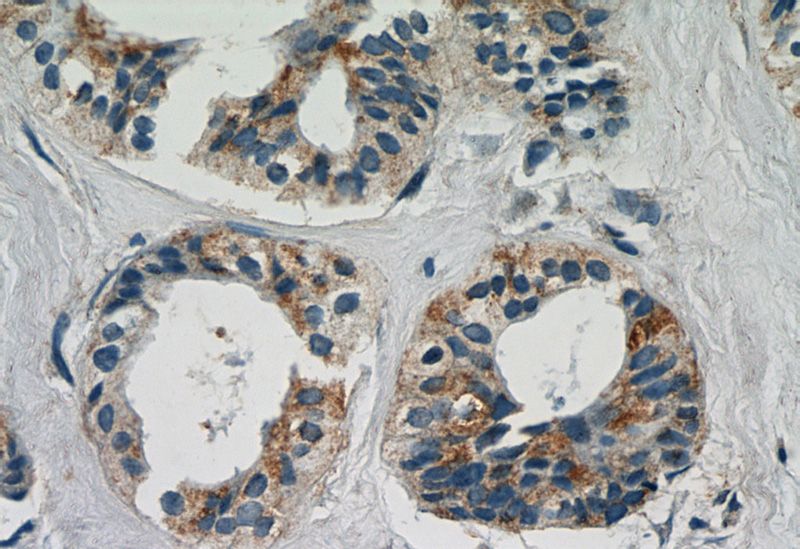 Immunohistochemistry of paraffin-embedded human breast cancer slide using Catalog No:112204(LGALS3BP Antibody) at dilution of 1:50 (under 40x lens)