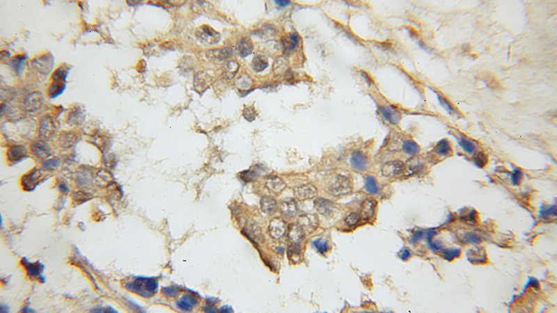 Immunohistochemical of paraffin-embedded human breast cancer using Catalog No:114572(EBAG9 antibody) at dilution of 1:50 (under 10x lens)