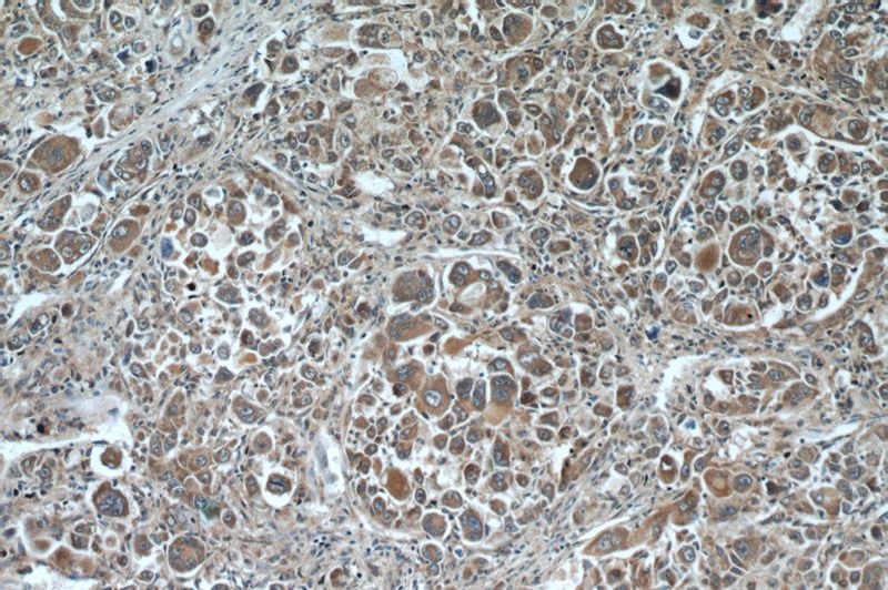 Immunohistochemistry of paraffin-embedded human liver cancer tissue slide using Catalog No:110059(DDC Antibody) at dilution of 1:50 (under 10x lens)