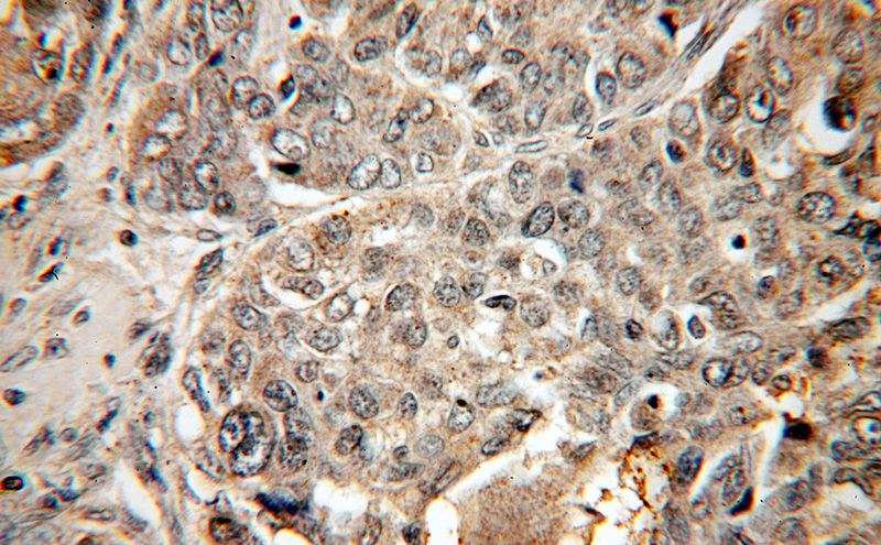 Immunohistochemical of paraffin-embedded human liver cancer using Catalog No:115420(SMAD4 antibody) at dilution of 1:50 (under 40x lens)