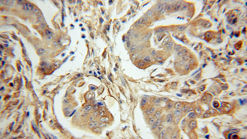 Immunohistochemical of paraffin-embedded human colon cancer using Catalog No:113970(PLK3 antibody) at dilution of 1:10 (under 10x lens)