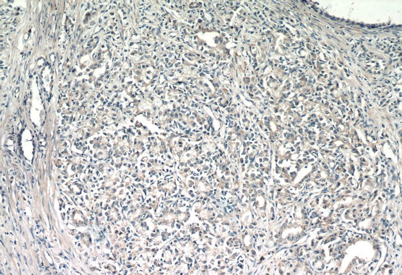 Immunohistochemistry of paraffin-embedded human prostate cancer tissue slide using Catalog No:116196(TMEM71 Antibody) at dilution of 1:50 (under 10x lens)