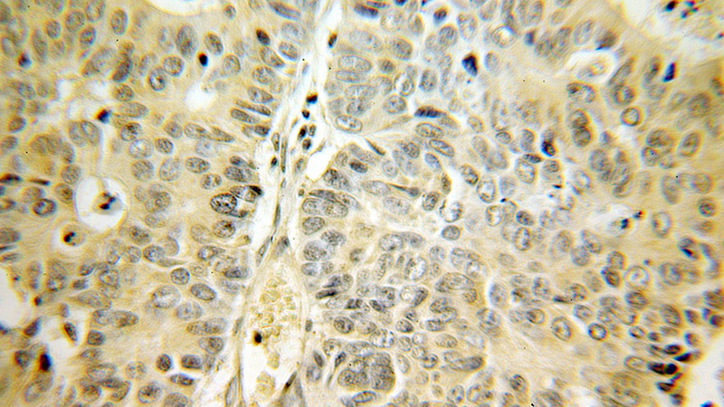Immunohistochemical of paraffin-embedded human colon cancer using Catalog No:115781(SDC3 antibody) at dilution of 1:100 (under 25x lens)