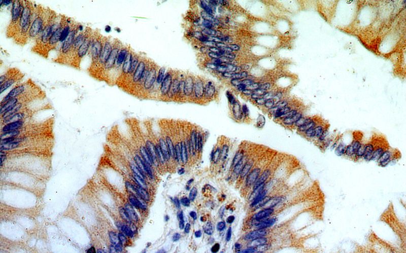 Immunohistochemical of paraffin-embedded human colon using Catalog No:114780(RocK2-Specific antibody) at dilution of 1:100 (under 40x lens)