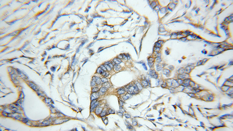Immunohistochemical of paraffin-embedded human pancreas cancer using Catalog No:111680(IGF2BP2 antibody) at dilution of 1:50 (under 10x lens)