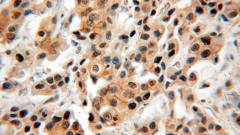 Immunohistochemical of paraffin-embedded human breast cancer using Catalog No:116603(USP28 antibody) at dilution of 1:50 (under 40x lens)