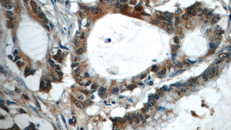 Immunohistochemistry of paraffin-embedded human colon cancer tissue slide using Catalog No:115981(TAF15 Antibody) at dilution of 1:50 (under 40x lens)
